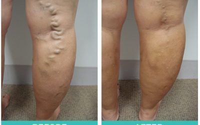 Varicose Veins: Miami Day Hospital Treatments Before and After