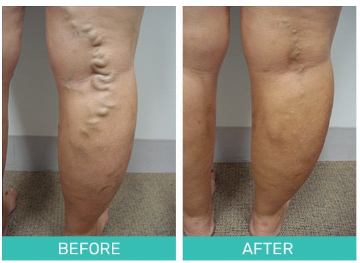 Varicose Veins: Miami Day Hospital Treatments Before and After